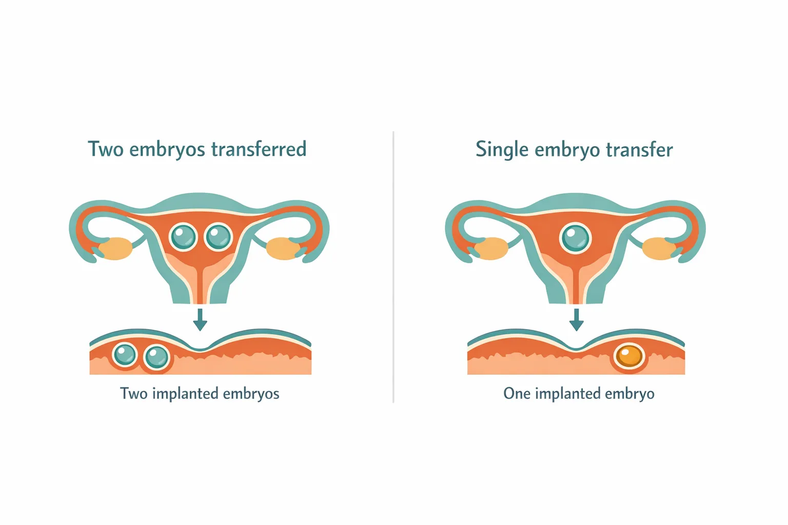Diagram comparing double versus single embryo transfer inside a uterus cross-section, illustrating why twins occur in IV